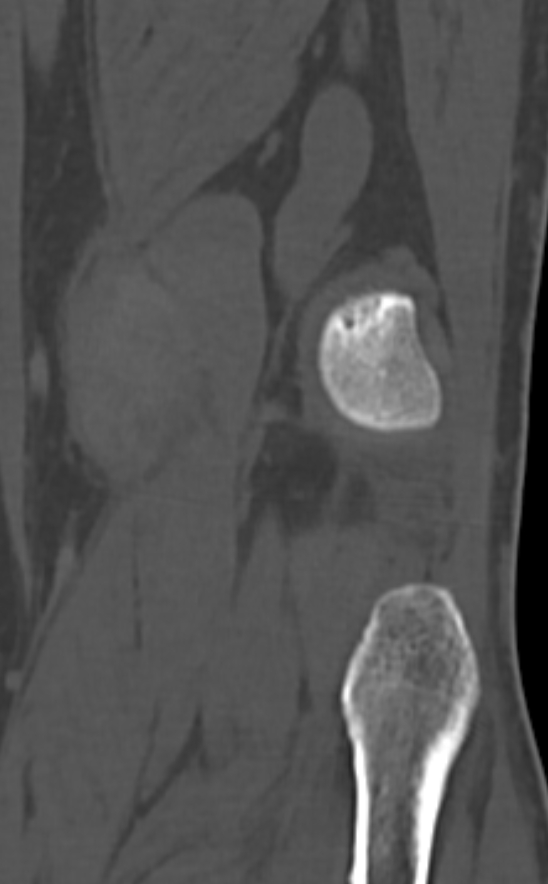Chondrocalcinosis (Radiopaedia 82862-97173 Coronal bone window 67).jpg
