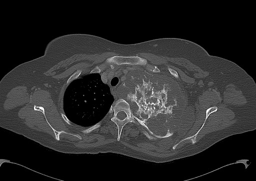 Chondrosarcoma - chest wall (Radiopaedia 65192-74199 Axial bone window 28).jpg
