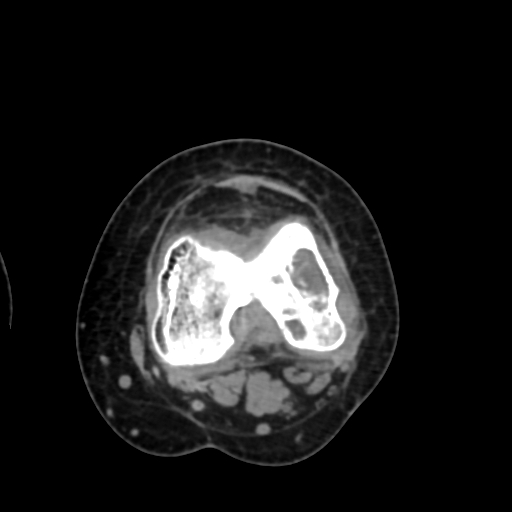 Chondrosarcoma - femur (Radiopaedia 64187-72954 Axial non-contrast 52).jpg