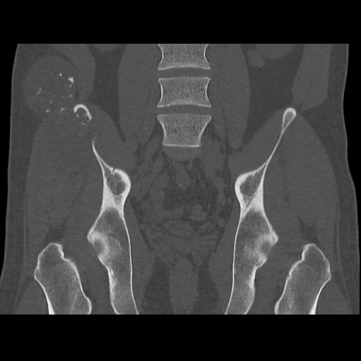 File:Chondrosarcoma of iliac wing (Radiopaedia 63861-72599 Coronal bone window 67).jpg