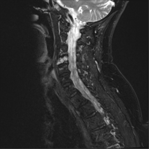 File:Chordoma (C4 vertebra) (Radiopaedia 47561-52189 Sagittal T2 fat sat 4).png