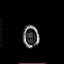 Choroid plexus xanthogranuloma (Radiopaedia 67843-77270 Axial T1 16).jpg
