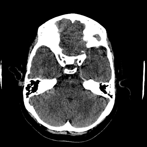 File:Choroid plexus xanthogranulomas (Radiopaedia 51621-57408 Axial non-contrast 26).jpg