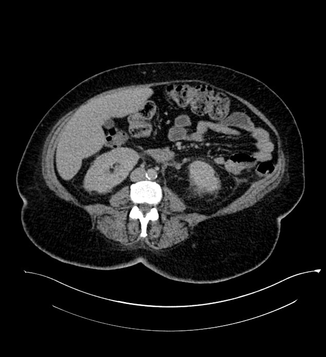 Chromophobe renal cell carcinoma (Radiopaedia 84239-99519 E 90).jpg