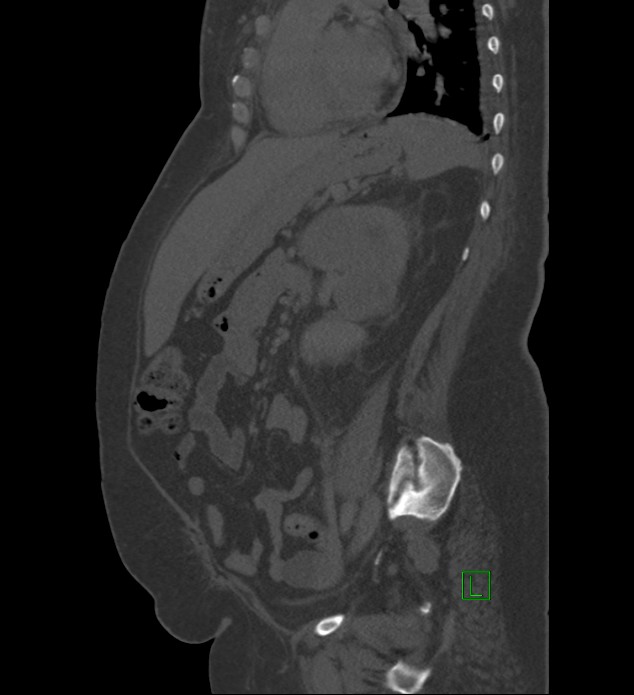 Chromophobe renal cell carcinoma (Radiopaedia 84239-99519 Sagittal bone window 39).jpg