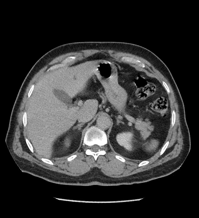 Chromophobe renal cell carcinoma (Radiopaedia 86879-103083 D 32).jpg