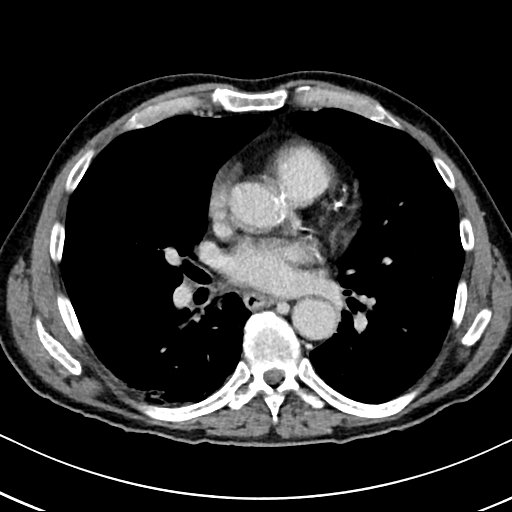 Chronic appendicitis complicated by appendicular abscess, pylephlebitis and liver abscess (Radiopaedia 54483-60700 B 3).jpg