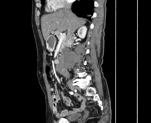Chronic contained rupture of abdominal aortic aneurysm with extensive erosion of the vertebral bodies (Radiopaedia 55450-61901 B 14).jpg
