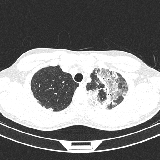Chronic eosinophilic pneumonia (Radiopaedia 39331-41587 Axial lung window 10).png