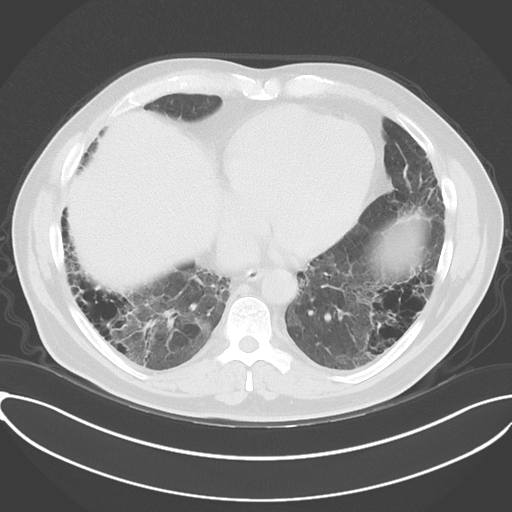 File:Chronic hypersensitivity pneumonitis (Radiopaedia 48107-52922 Axial lung window 43).png