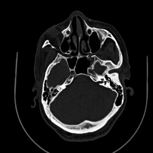 Chronic invasive fungal sinusitis (Radiopaedia 91563-109286 Axial sinus 50).jpg