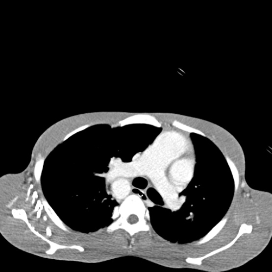 Chronic large bowel pseudo-obstruction (Radiopaedia 43181-46492 A 5).jpg