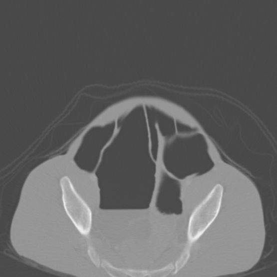 Chronic large bowel pseudo-obstruction (Radiopaedia 43181-46492 Axial bone window 143).jpg