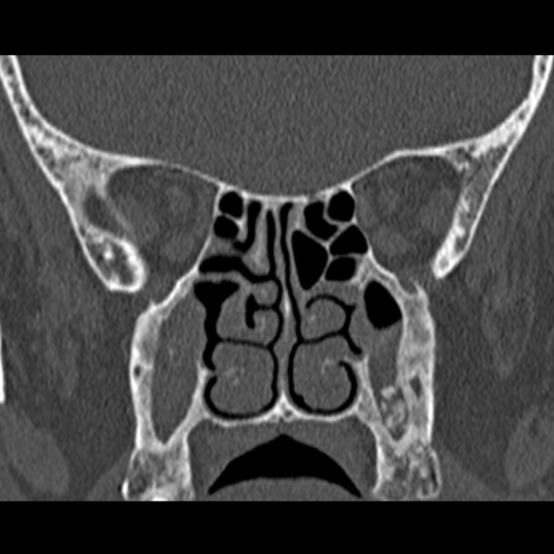 Chronic maxillary sinusitis (Radiopaedia 27879-28116 Coronal bone window 32).jpg