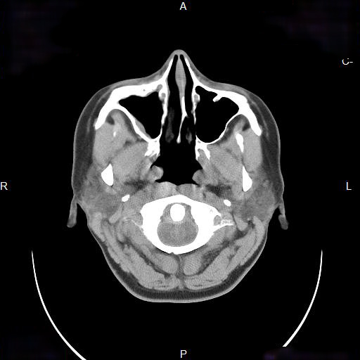 File:Chronic maxillary sinusitis with a foreign body (dental filling material) (Radiopaedia 7811-8639 Axial non-contrast 4).jpg