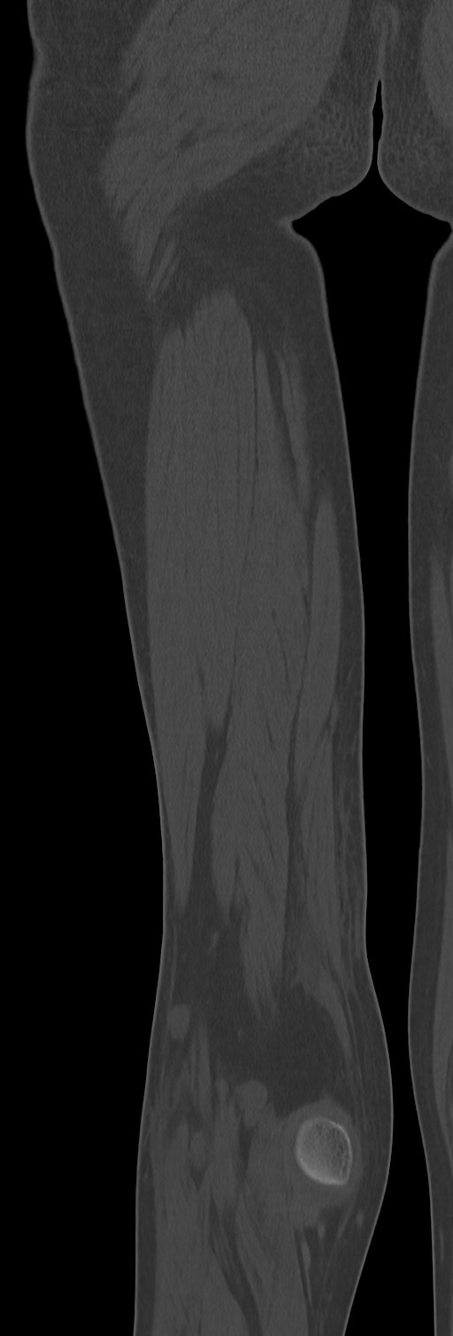 Chronic ostemyelitis of the femur with long sinus tract (Radiopaedia 74947-85982 Coronal bone window 65).jpg