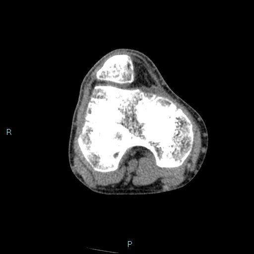 Chronic osteomyelitis (with Brodie abscess) (Radiopaedia 76405-88111 A 137).jpg