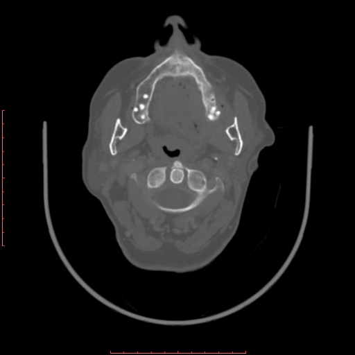 Chronic osteomyelitis - maxilla (Radiopaedia 23783-23927 Axial bone window 79).jpg