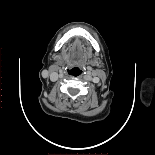 File:Chronic osteomyelitis - maxilla (Radiopaedia 23783-23927 B 2).jpg