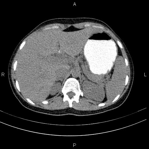 Chronic pancreatitis (Radiopaedia 64576-73450 Axial non-contrast 30).jpg