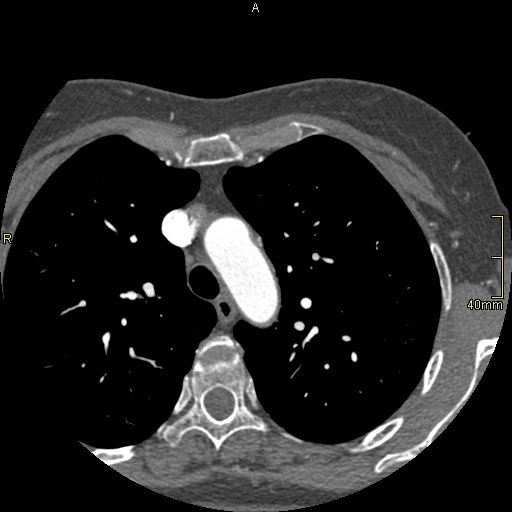 Chronic pulmonary embolism (Radiopaedia 73073-85094 Axial C+ CTPA 20).jpg
