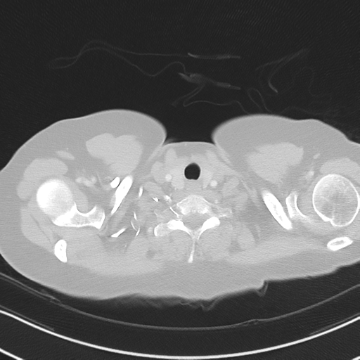Chronic pulmonary embolus (Radiopaedia 39129-41341 Axial lung window 4).png