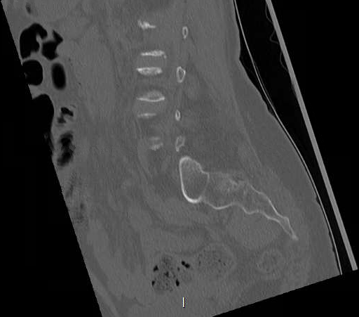 File:Chronic spinal hematoma with cauda equina syndrome (Radiopaedia 75745-88197 Sagittal bone window 24).png