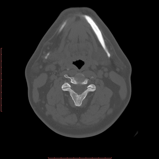 Chronic submandibular sialolithiasis (Radiopaedia 69817-79814 Axial bone window 82).jpg