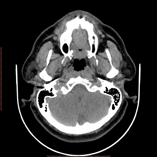 Chronic submandibular sialolithiasis (Radiopaedia 69817-79814 Axial non-contrast 27).jpg