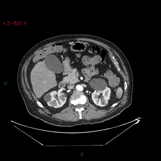 File:Circumaortic left renal vein and doubled left renal arteries (Radiopaedia 52268-58158 A 67).jpg