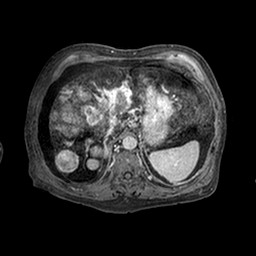 Cirrhosis and hepatocellular carcinoma in the setting of hemochromatosis (Radiopaedia 75394-86594 Axial T1 C+ fat sat 311).jpg