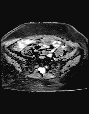 File:Class II Mullerian duct anomaly- unicornuate uterus with rudimentary horn and non-communicating cavity (Radiopaedia 39441-41755 Axial ADC 4).jpg