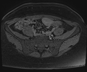 File:Class II Mullerian duct anomaly- unicornuate uterus with rudimentary horn and non-communicating cavity (Radiopaedia 39441-41755 Axial T1 fat sat 1).jpg