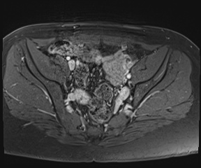 File:Class II Mullerian duct anomaly- unicornuate uterus with rudimentary horn and non-communicating cavity (Radiopaedia 39441-41755 Axial T1 fat sat 42).jpg
