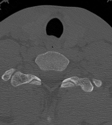 Clay-shoveler fracture (Radiopaedia 14604-14532 Axial bone window 44).jpg