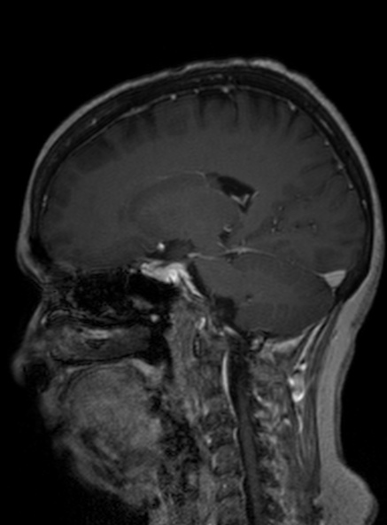 Clival meningioma (Radiopaedia 53278-59248 Sagittal T1 C+ 231).jpg