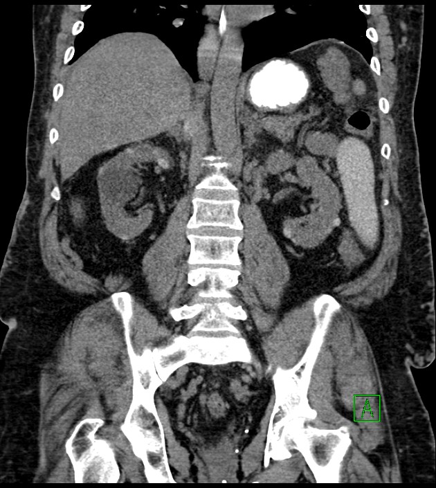 Closed-loop small bowel obstruction-internal hernia (Radiopaedia 78439-91096 Coronal non-contrast 66).jpg