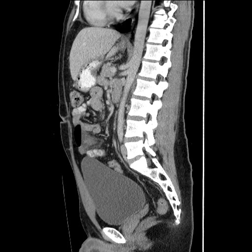 Closed-loop small bowel obstruction (Radiopaedia 73713-84509 B 93).jpg