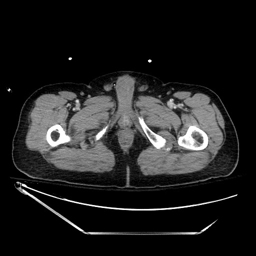 File:Closed loop obstruction due to adhesive band, resulting in small bowel ischemia and resection (Radiopaedia 83835-99023 D 172).jpg