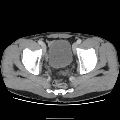 Closed loop small bowel obstruction (Radiopaedia 59227-66554 A 76).jpg