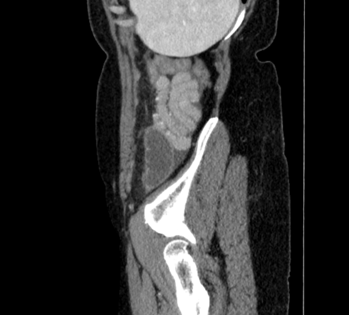 Closed loop small bowel obstruction (Radiopaedia 71211-81508 C 150).jpg