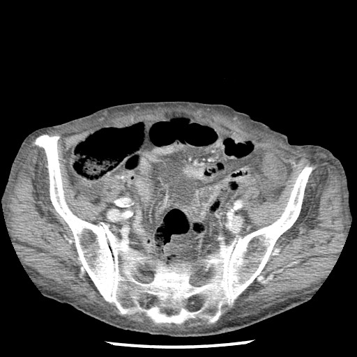 File:Closed loop small bowel obstruction - adhesions and infarct (Radiopaedia 85125-100678 B 76).jpg