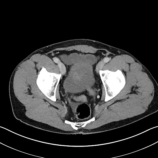 Closed loop small bowel obstruction - internal hernia (Radiopaedia 57806-64778 B 114).jpg