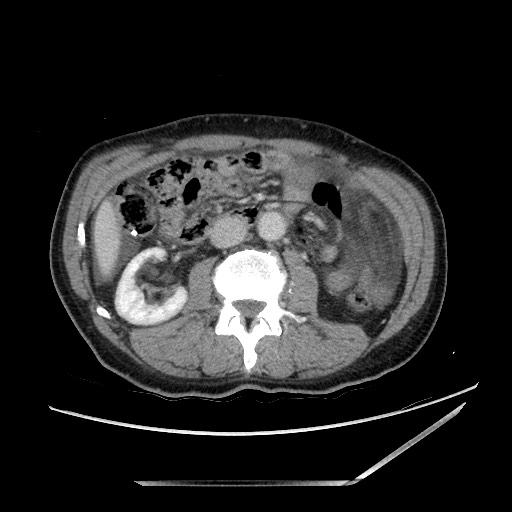Closed loop small bowel obstruction - omental adhesion causing "internal hernia" (Radiopaedia 85129-100682 A 77).jpg