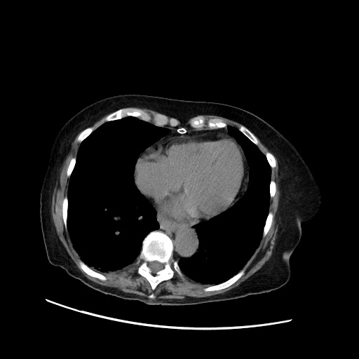 File:Closed loop small bowel obstruction due to adhesive band, with intramural hemorrhage and ischemia (Radiopaedia 83831-99017 Axial non-contrast 18).jpg
