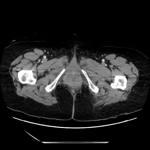 File:Closed loop small bowel obstruction due to adhesive bands - early and late images (Radiopaedia 83830-99014 A 172).jpg
