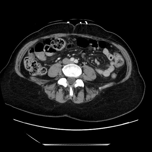 File:Closed loop small bowel obstruction due to adhesive bands - early and late images (Radiopaedia 83830-99014 A 88).jpg