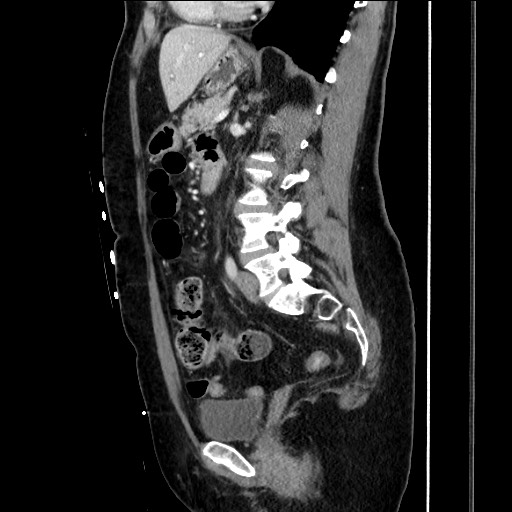 Closed loop small bowel obstruction due to adhesive bands - early and late images (Radiopaedia 83830-99014 C 105).jpg