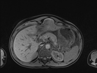 Closed loop small bowel obstruction in pregnancy (MRI) (Radiopaedia 87637-104031 Axial T1 fat sat 33).jpg
