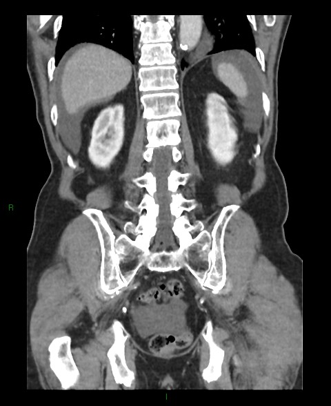 Closed loop small bowel obstruction with ischemia (Radiopaedia 84180-99456 B 15).jpg
